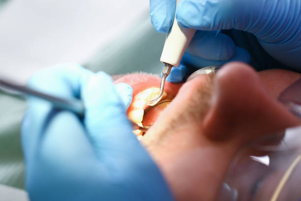 Best Emergency Tooth Extraction in Grass Lake, MI