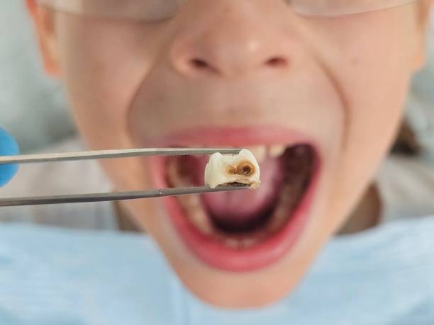 Best Emergency Gum Treatment in Grass Lake, MI